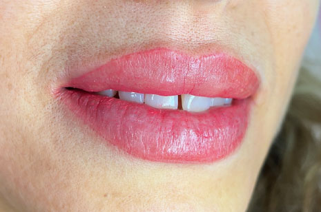 Micropigmentación de Labios